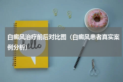 白癜风治疗前后对比图（白癜风患者真实案例分析）